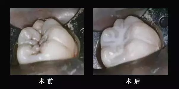 給寶寶做窩溝封閉的4個(gè)最佳時(shí)機(jī) 